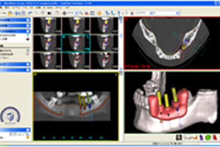 インプラント術前シミュレーションシステム