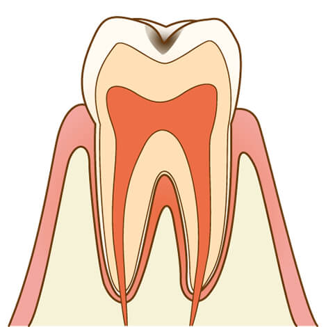 虫歯の進行度：C1