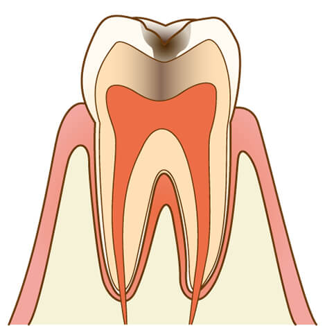 虫歯の進行度：C2