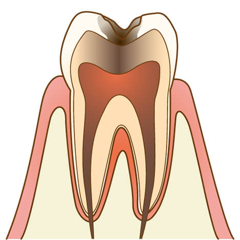 虫歯の進行度：C3