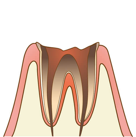 虫歯の進行度：C4