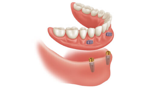 ロケーター義歯：インプラント固定式の入れ歯