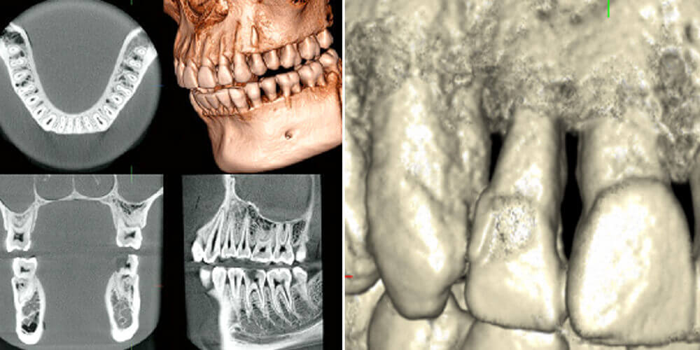 歯科用CTの活用