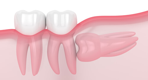 2段階抜歯(保険外治療)